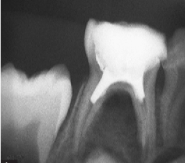 Deciduous Pulpectomy